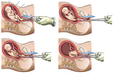 Проведение хирургического аборта