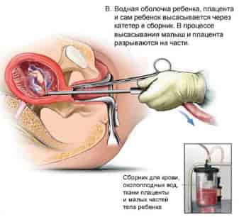 Вакуумный аборт.Водная оболочка ребенка